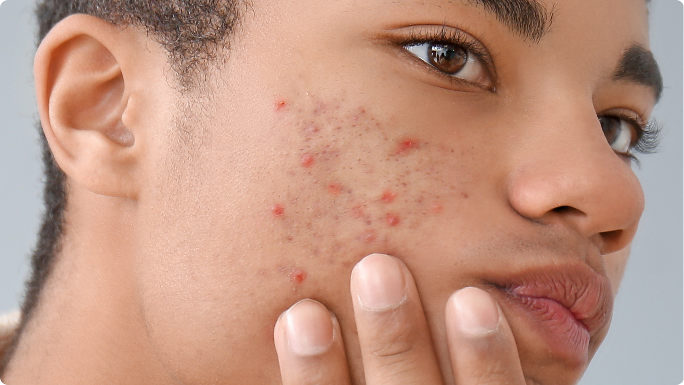 What is Hypochlorous Acid? Is it really safe for skincare?