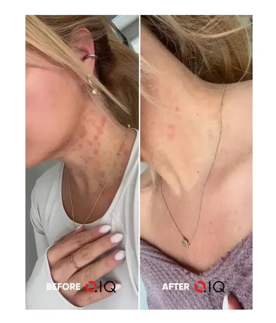 Before and after photos showing Bianca's skin on her neck and chest