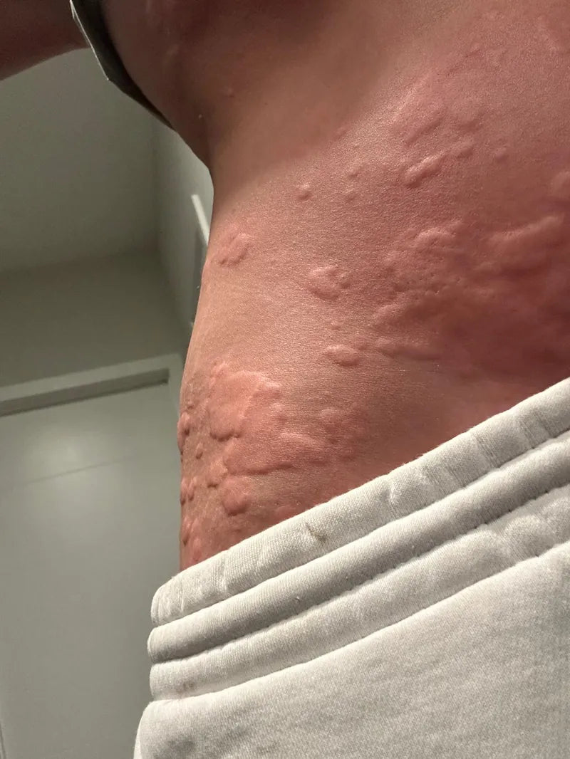 Unedited customer photo of raised hives along the torso during a flare-up