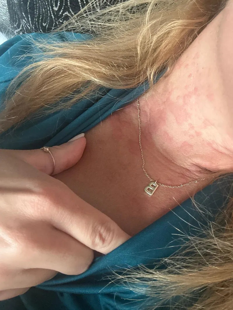 Unedited customer photo of hives on the neck and chest during a flare-up